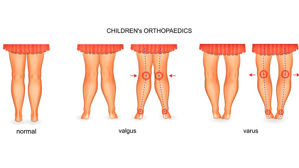 Варусная деформация стопы у детей фото